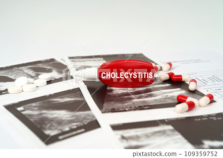 On the ultrasound pictures there are pills and a pen with the inscription - Cholecystitis 109359752