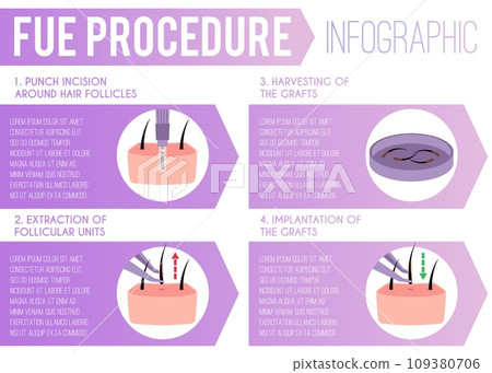 Medical infographic about hair transplantation and fue procedure, vector 109380706