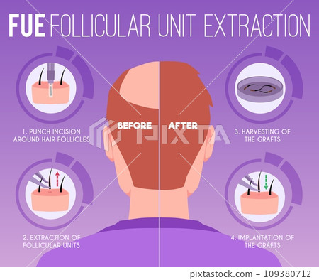 Hair transplantation, medical infographic with man, vector illustration Hair transplantation, medical infographic with man, vector illustration 109380712