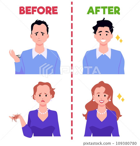 Bald woman and man before and after hair transplantation infographic, head baldness problem solving surgery, alopecia Bald woman and man before and after hair transplantation infographic, head baldness problem solving surgery, alopecia 109380780