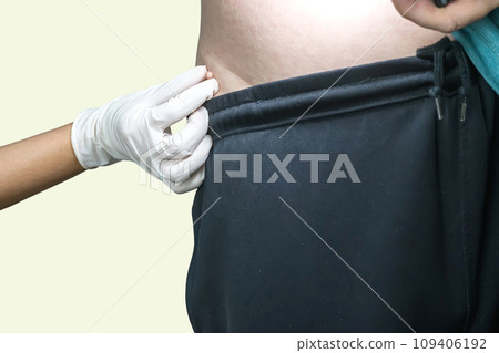 Skin tag or acrochondon or soft fibroma Skin tag or acrochondon or soft fibroma 109406192
