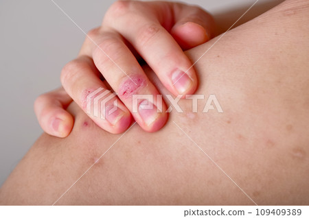 A man concerned about atopic dermatitis on his back 109409389