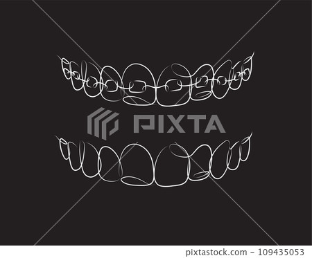 Jaws with and without braces installed black color 109435053
