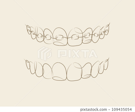 Jaws with and without braces installed beige color Jaws with and without braces installed beige color 109435054