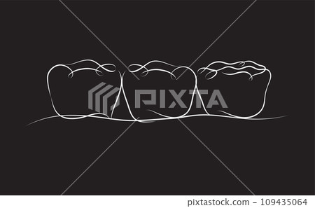 Implanted teeth with crown bridge black color 109435064