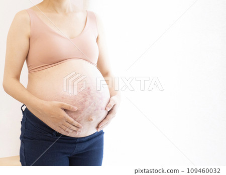 Pregnant woman putting her hand on her stomach with stretch marks and midline 109460032