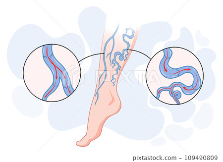 Varicose veins. Blue blood vessel visible through the skin, abnormally swollen leg. Vascular disease diagnostic and treatment. Venous insufficiency medical disease Varicose veins. Blue blood vessel visible through the skin, abnormally swollen leg. Vascular disease diagnostic and treatment. Venous insufficiency medical disease 109490809
