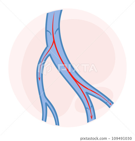 Varicose veins. Blue blood vessel visible through the skin. Vascular disease diagnostic and treatment. Venous insufficiency medical Varicose veins. Blue blood vessel visible through the skin. Vascular disease diagnostic and treatment. Venous insufficiency medical 109491030
