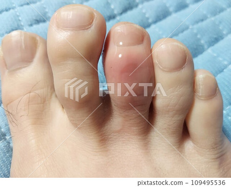 【右腳中趾痛風】持續發展 109495536
