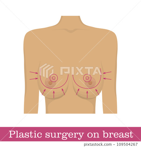 Plastic surgery breast reduction infographic Plastic surgery breast reduction infographic 109504267