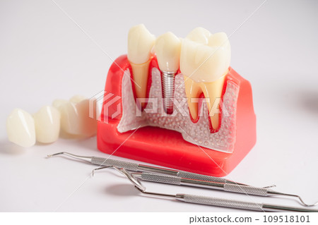 Dental implant, artificial tooth roots into jaw, root canal of dental treatment, gum disease, teeth model for dentist studying about dentistry. 109518101