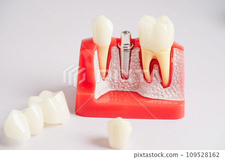 Dental implant, artificial tooth roots into jaw, root canal of dental treatment, gum disease, teeth model for dentist studying about dentistry. 109528162