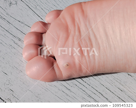 warts on the soles of the feet 109545323