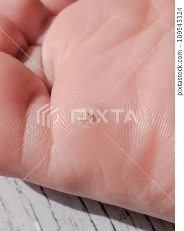 warts on the soles of the feet 109545324