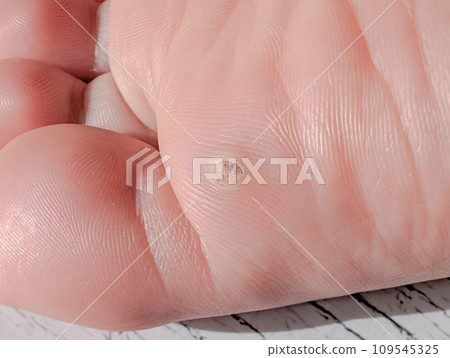 warts on the soles of the feet 109545325