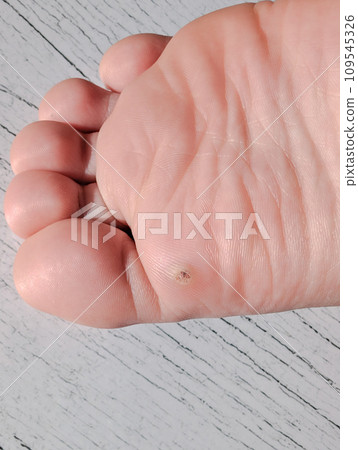 warts on the soles of the feet 109545326