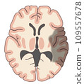 Horizontal section of cerebral infarction 109557678