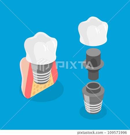 3D Isometric Flat Vector Illustration of Tooth implant 109571996
