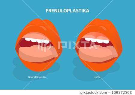 3D Isometric Flat Vector Illustration of Frenuloplastika 109572508