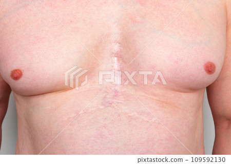 A young caucasian man with a scar on his chest due to a heart surgery. Concept of personal improvement. A young caucasian man with a scar on his chest due to a heart surgery. Concept of personal improvement. 109592130