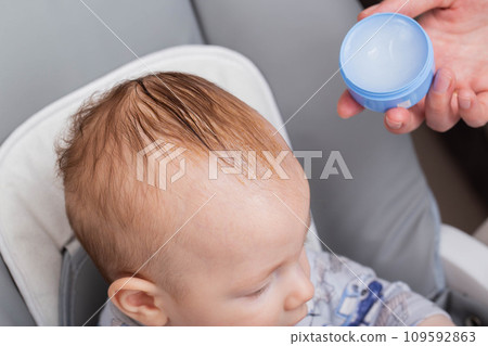 Applying a special cream and oil to the child's scalp to remove gneiss or seborrheic crust. Yellow scales on the scalp, close-up. Dermatology 109592863