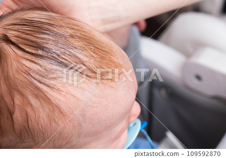 Smearing a seborrheic crust with baby oil on a child's head. Combing and removal of seborrheic crust, close-up 109592870