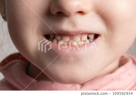 Beautiful smile of a child without one tooth. Change of milk teeth. Extraction of teeth for children in surgical dentistry, close-up 109592934