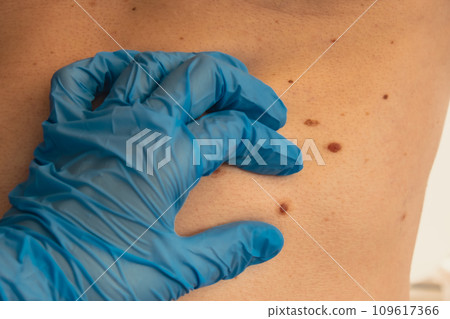 Doctor in medical gloves examining man skin mole. Dermatologist checking male birthmarks. Self care preventing cancer procedure. Protection treatment skin positivity 109617366