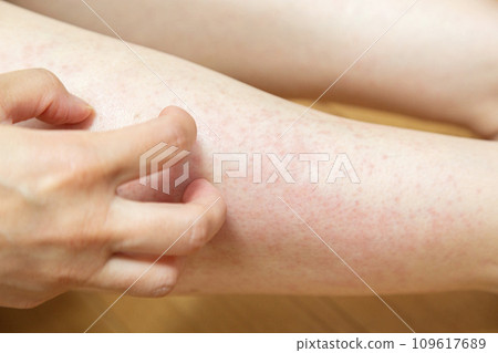 Itchy feet due to eczema 109617689