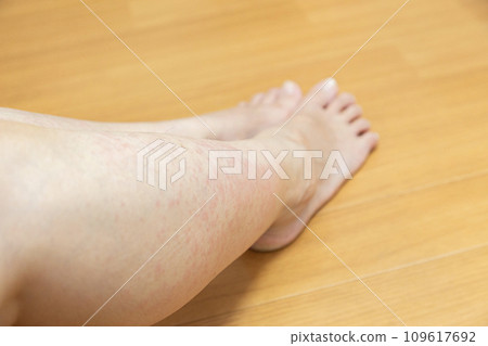 腳有濕疹 109617692