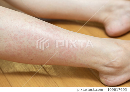 腳癢並伴有蕁麻疹 腳癢並伴有蕁麻疹 109617693