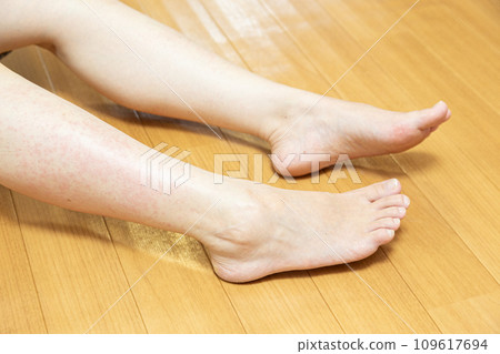 腳癢並伴有蕁麻疹 109617694