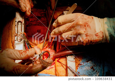 Patient during surgical procedure at open heart in operation room 109638431