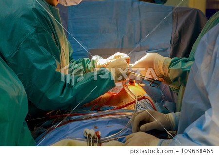 During heart valve surgery, patient undergoes procedure to remove expandable transcatheter aorta 109638465