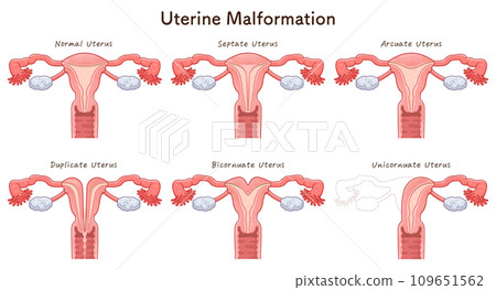 Uterine malformation 109651562