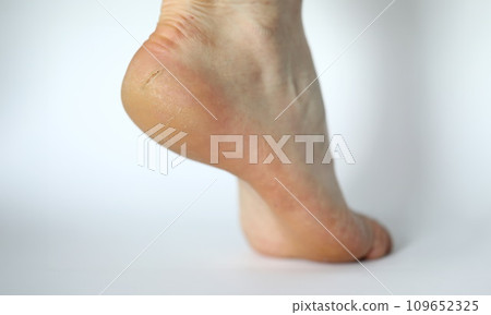 Painful cracked skin on foot 109652325