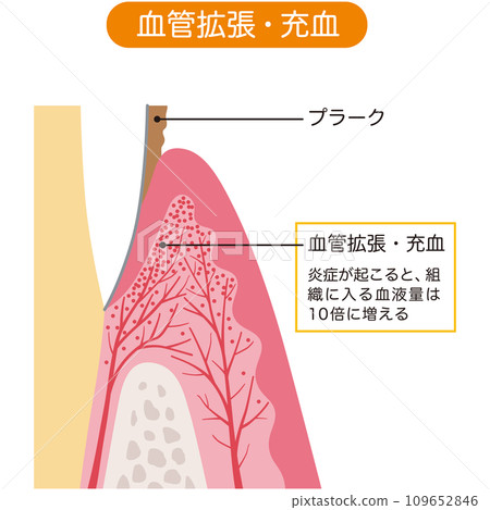 Cross section of engorged gums dental medical care Cross section of engorged gums dental medical care 109652846
