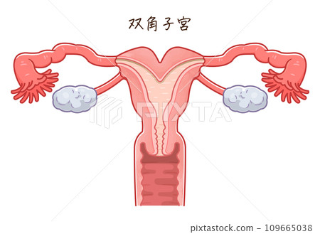 Uterine malformation Uterine malformation 109665038