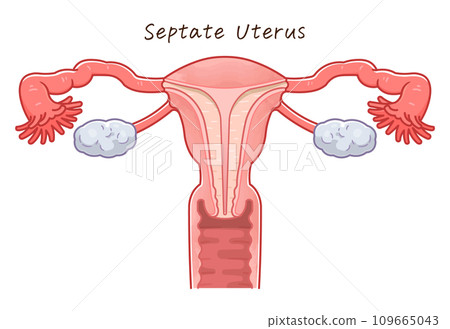 Uterine malformation 109665043