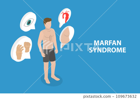 3D Isometric Flat Vector Illustration of Marfan Syndrome 3D Isometric Flat Vector Illustration of Marfan Syndrome 109673632