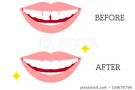 Cosmetic dentistry, before and after direct bonding 109676799