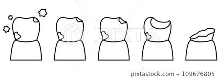 Image illustration of the progression of tooth decay, simple line drawing Image illustration of the progression of tooth decay, simple line drawing 109676805
