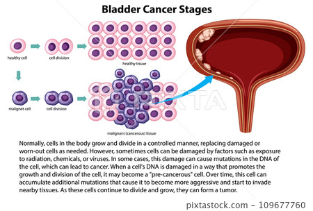 Informative Bladder Cancer Stages Informative Bladder Cancer Stages 109677760