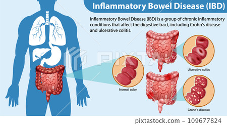 Inflammatory Bowel Disease (IBD) Infographic Inflammatory Bowel Disease (IBD) Infographic 109677824