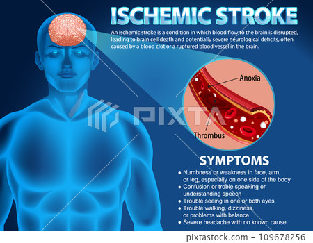 Informative poster of Ischemic stroke Informative poster of Ischemic stroke 109678256