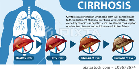 Informative poster of alcoholic liver disease Cirrhosis Informative poster of alcoholic liver disease Cirrhosis 109678674