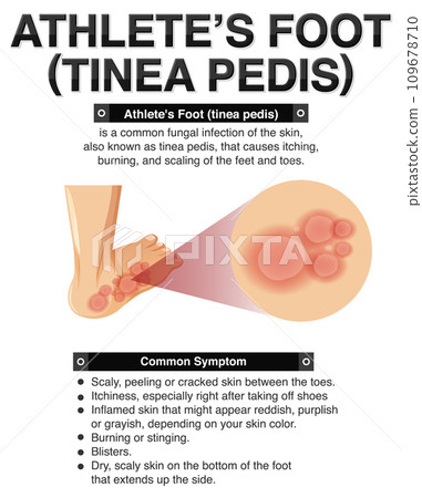 Informative poster of Athlete foot 109678710