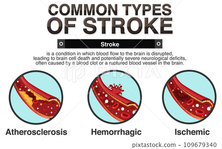Informative poster of common types of stoke 109679340