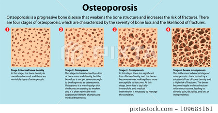 Bone Density and Osteoporosis Vector 109683161