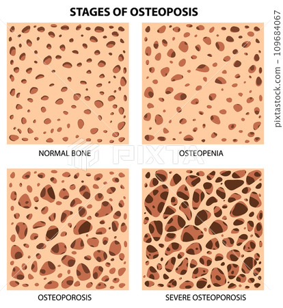 Stages of Osteoposis Vector Stages of Osteoposis Vector 109684067